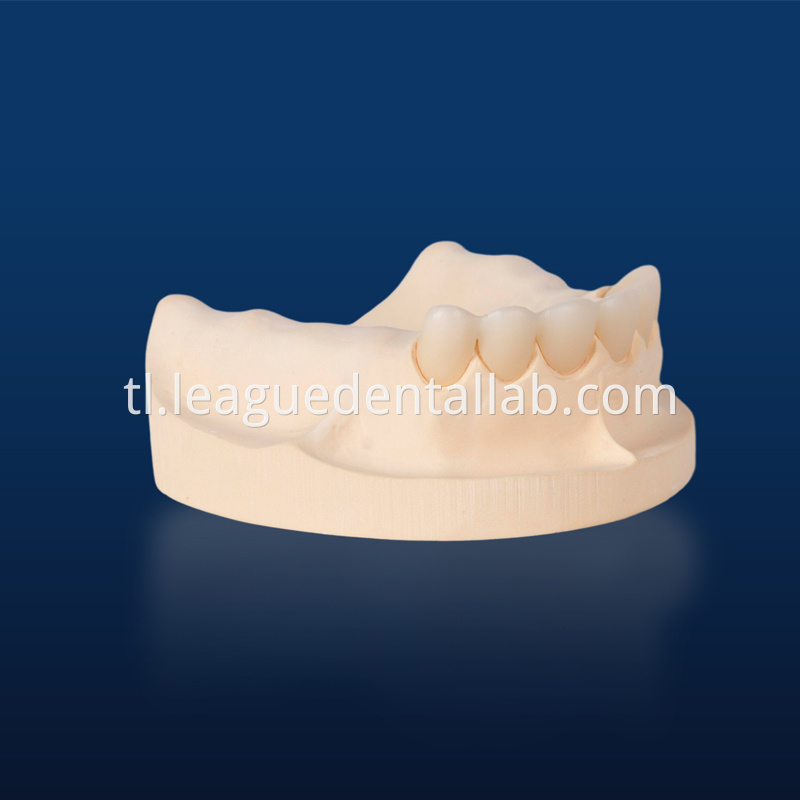 PFZ,Porcelain Fused to Zirconia,Zirconia Layered, Zirconia Veneered